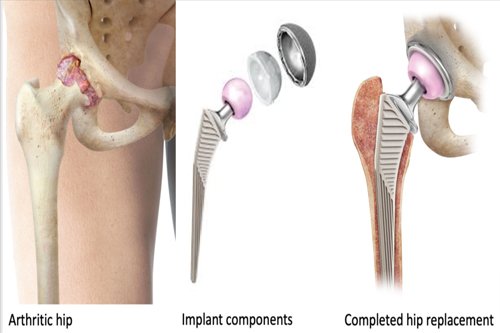hip replacement surgery explain in details