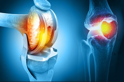 joint replacement knee artificial