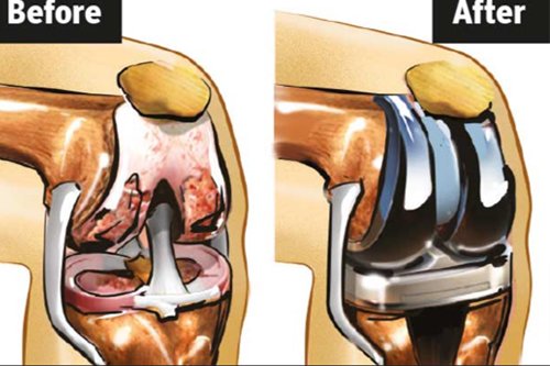 Knee Joint Preservation after before surgery shows knee