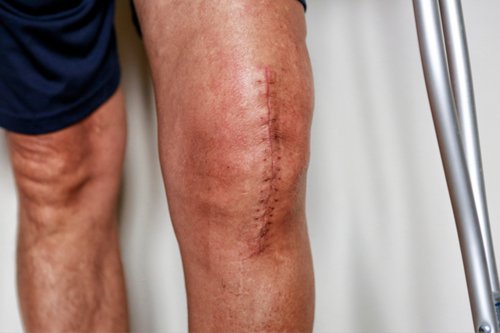 Knee Replacement after surgery shows patient legs knee