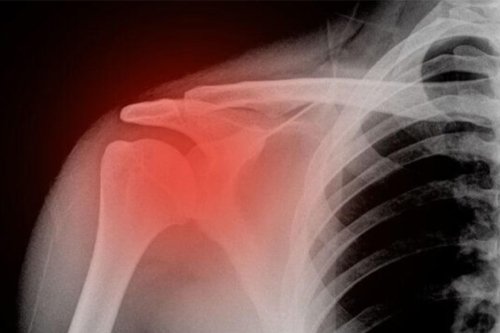 Shoulder Fracture red shows on bones pain