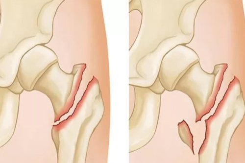 joint fracture bones crack image shows