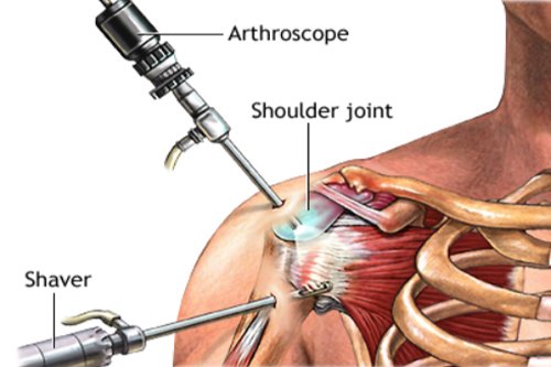 Shoulder Arthroscopy on joint instrument