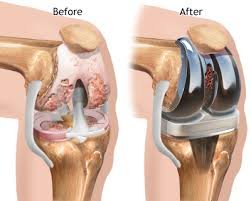 Knee Replacement In Nagpur