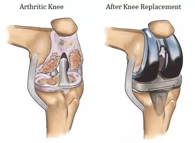 Knee Replacement Surgery In Nagpur