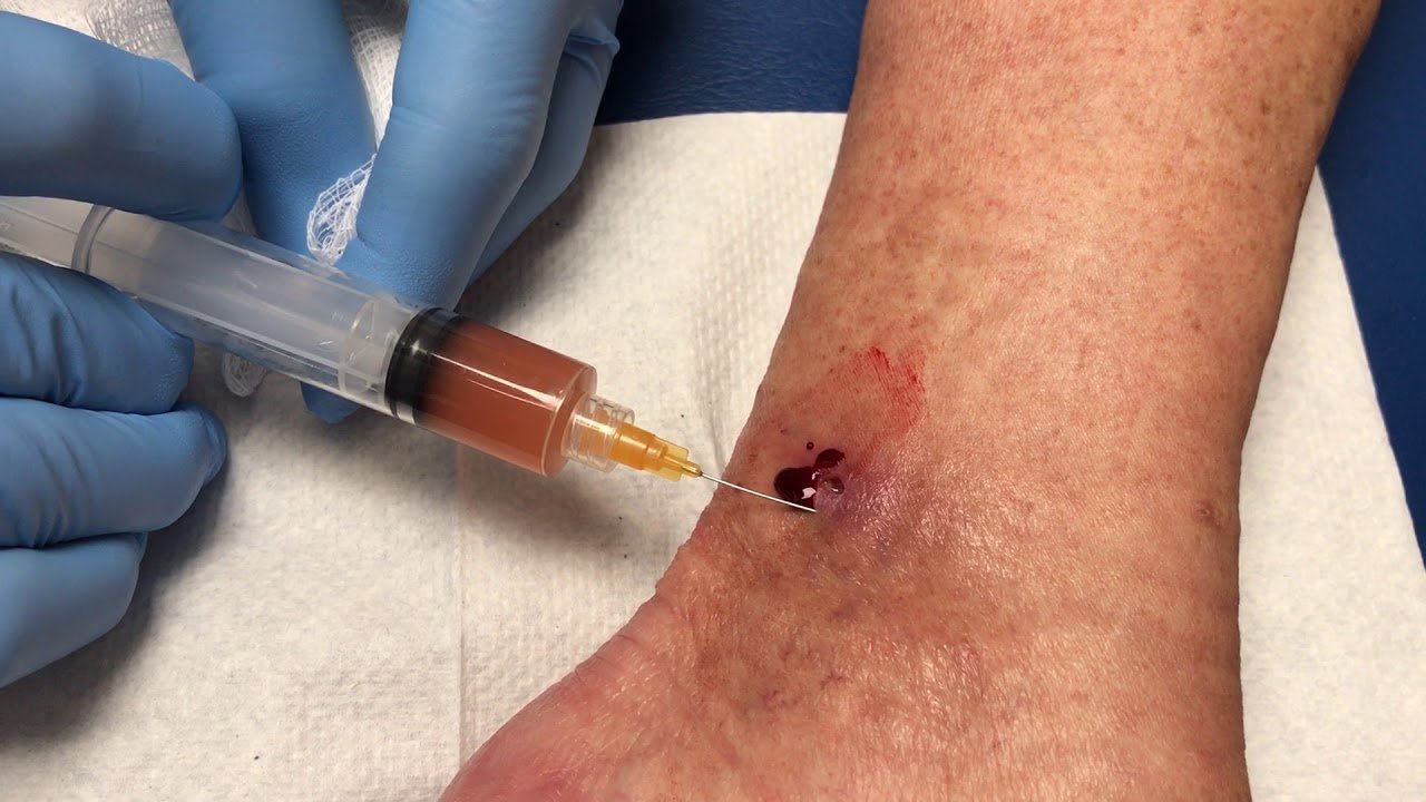 Treatment Of Non Healing Ulcer By PRP Injection